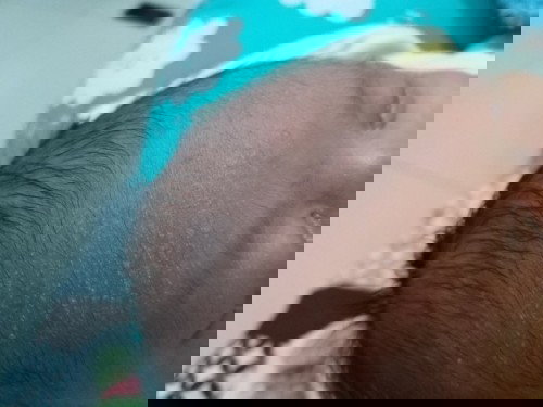 Bruntus putih di jidat