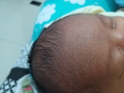 Bruntus putih di jidat