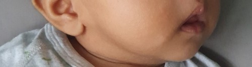 Skin discoloration?