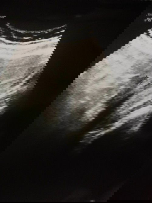 สวัสดีค่ะ  วันนี้ไปพบหมอมาหมออัลฯแล้วพบถุงตั้งครรภ์จริงแต่หมอบอกว่าถุงไม่ค่อยสวย อายุครรภ์ 5 วีค