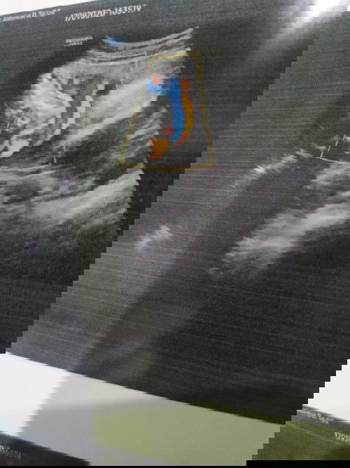 janin terlilit tali pusat