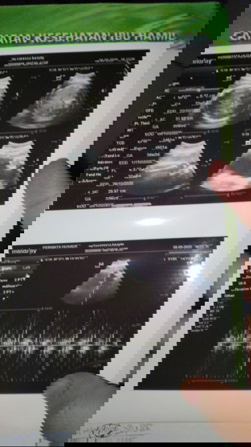 Berat badan janin 34 week