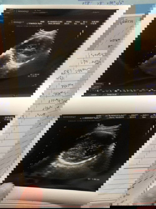 มีแม่บ้านไหนพบถุงน้ำในสมองตอน8เดือนบ้างคะ