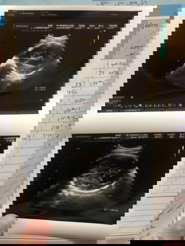 มีแม่บ้านไหนพบถุงน้ำในสมองตอน8เดือนบ้างคะ