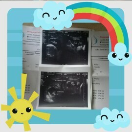 Pwede bang manganak ng normal kapag twins ? twins po kc yung baby ko . boy and girl