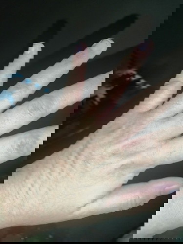 Intense itch in hands and feet