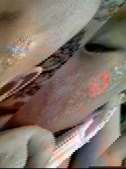 Bun ini eksim bukan ya