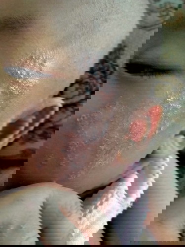 Bun ini eksim bukan ya