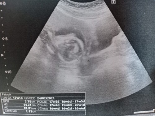 ใครเคยมีประสบการณ์ปากมดลูกสั้นไหมคะ