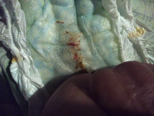 Blood on feces