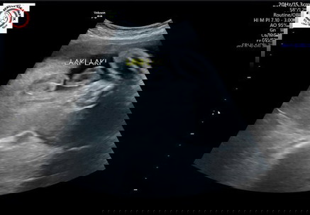 Usia kehamilan 29 minggu... Jk sudah terliahat apakah ini udah positif bunda bunda?