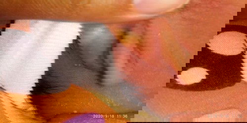 Bintik Putih kek jerawat