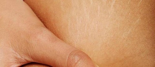 PENCEGAH STRETCH MARKS