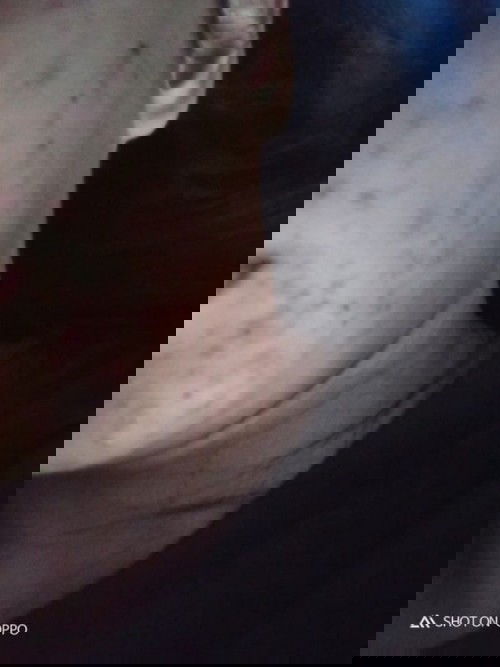 สิว / ผื่น/คัน