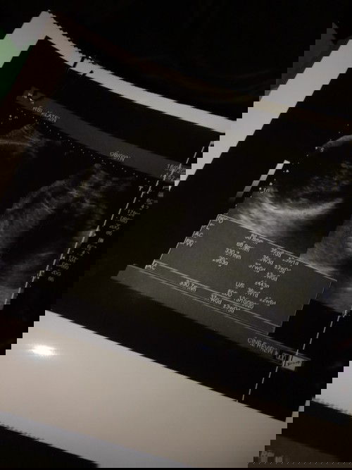 Lupa hpht, apa bisa pakai acuan EDD di USG?