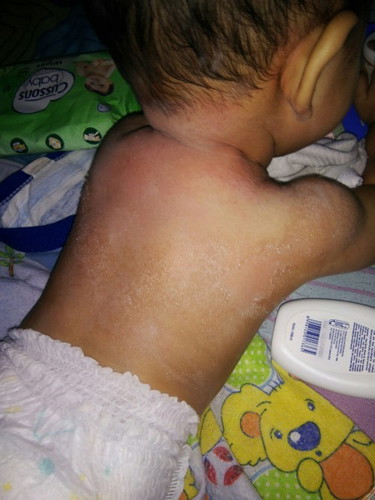 kulit bayi mengelupas dan merah2