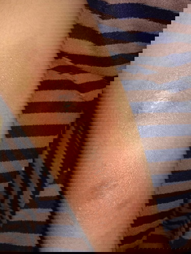 Moms, ada yg sma ga pas hml kena herpes/infeksi kulit, share dong gmn ngtasiny..