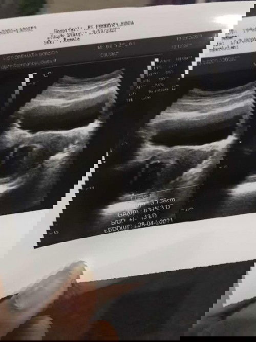 Usg 8w usia kandungan asli 7w