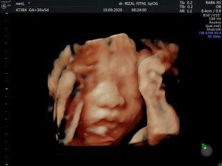 Awal kehamilan di vonis abortus incomplete (keguguran sebagian)