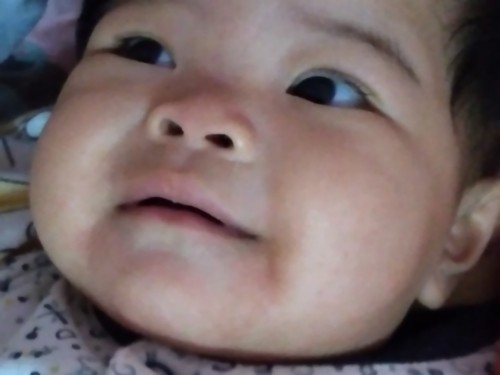 ลูกเป็นผื่นแดงจากเล่นน้ำลาย และน้ำนมน่าจะเป็นสาเหตุด้วยรักษายังไงคะ