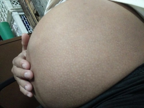 magiging kamot po ba yan mga mommy kapag nanganak ako? o mawawala naman yang mga itim itim na yan?