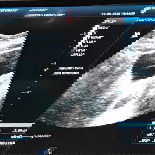 Mengulang usg diklinik karna janin tidak terlihat saat usg di rs