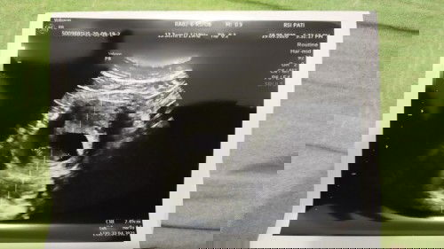 Kantung kehamilan mengelupas di kehamilan 9 minggu