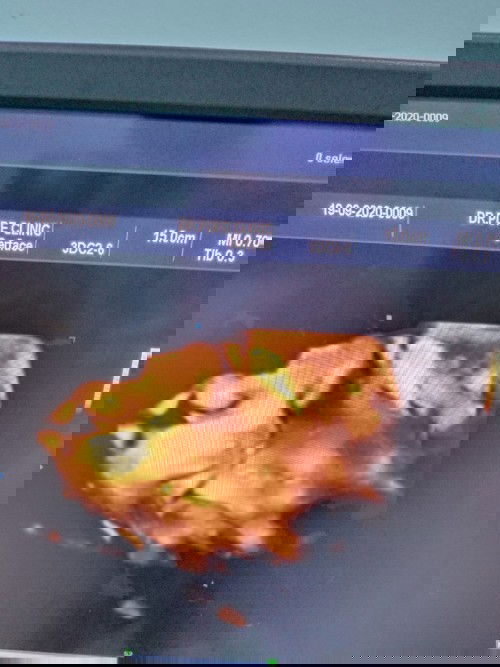 29week หมอบอกสายสะดือพันคอน้อง