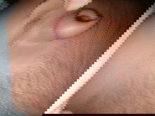 Telinga Belakang Bayi Lecet