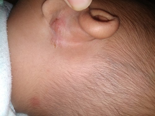 Telinga Belakang Bayi Lecet