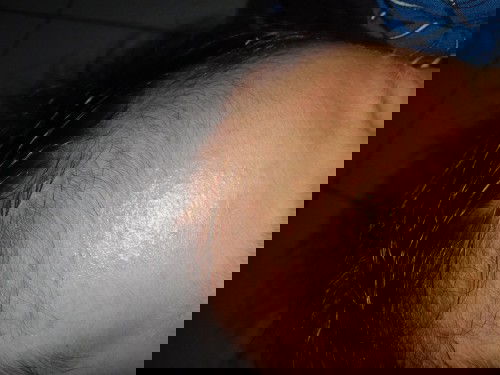 wajah bruntusan merah