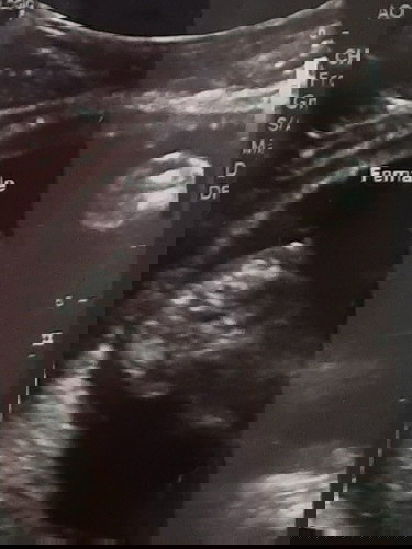 ultrasound at 20 weeks