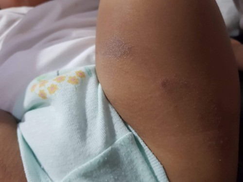 Dry skin for baby