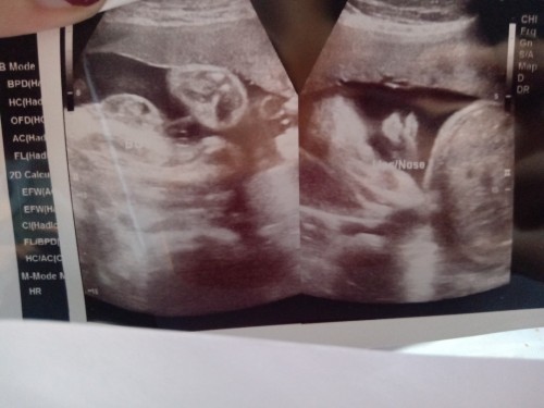 di po magets ung ultrasound pic