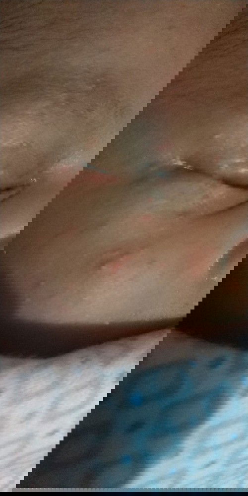 Bintik merah pada bayi