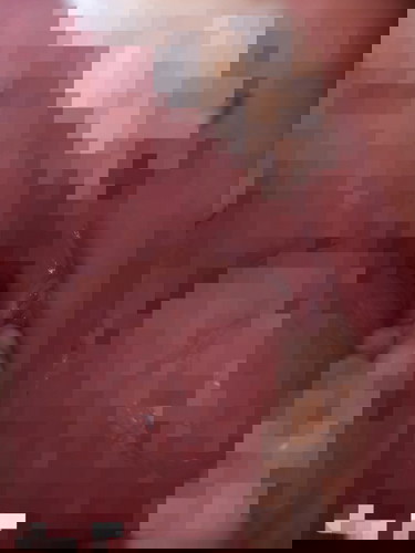 ฟันคุดแตก ตั้งครรภ์ได้26w