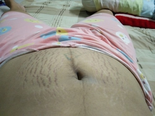 ท้องแตกลาย