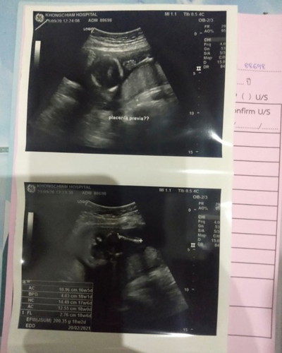 #ภาวะรกเกาะต่ำ แม่ๆคนใหนเป็นบ้างคะ??