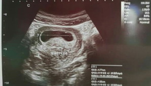 Kantung kosong @ 8 weeks+