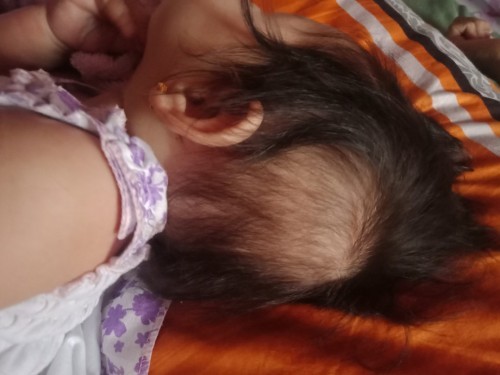 Naglalagas buhok ni baby