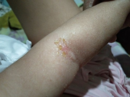 Rashes ni baby