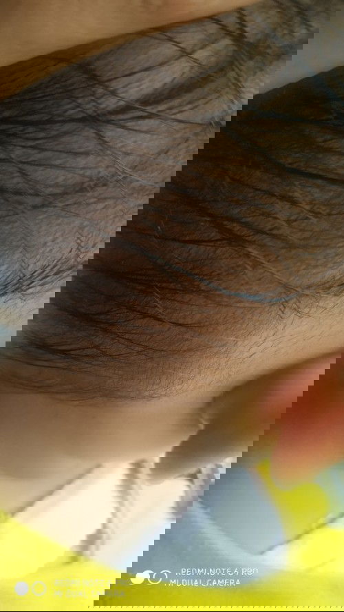 benjolan kecil di pinggir kepala