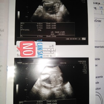 ดูรูปอัลตราซาวนด์ไม่เป็นค่ะ