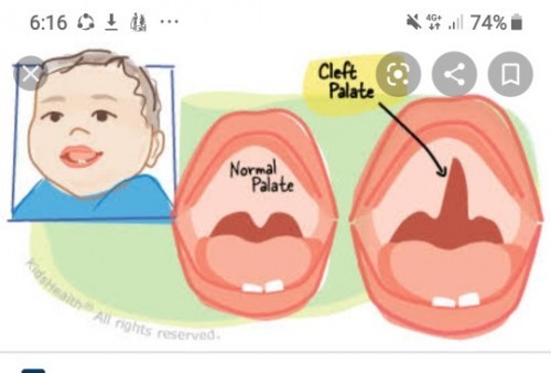 clift palate