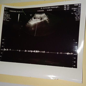 Bun saya bingung harus bagaimana? Kata dokter detak jantung janin lemah, umur kehamilan 10week..