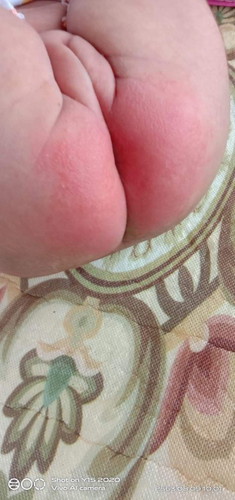 ก้นน้องเป็นพื่นเเดง