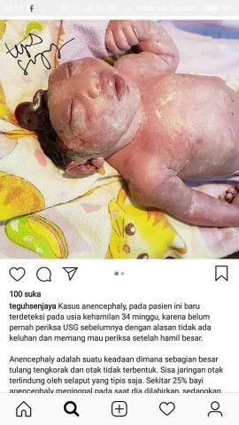 kasus anencephaly