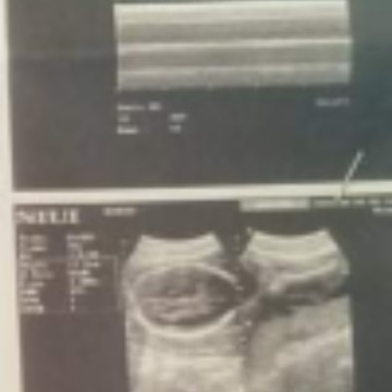 felvic ultrasound