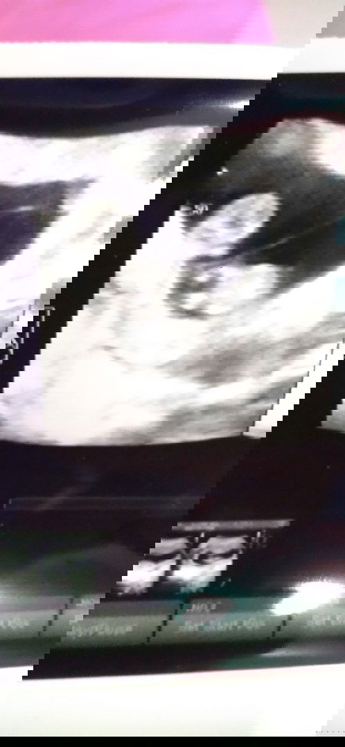 Kembar 1 kantong atau 2 kantong