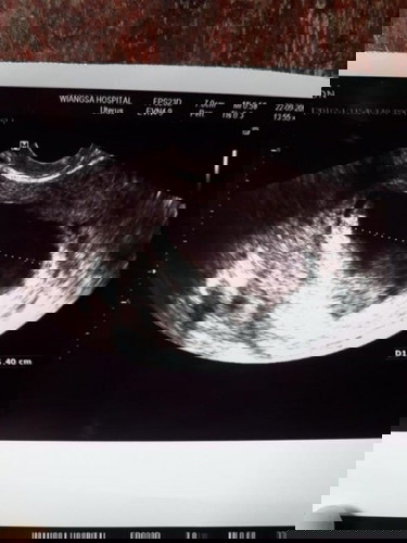 แบบนี้จะใช่ท้องลมไหมค่ะ